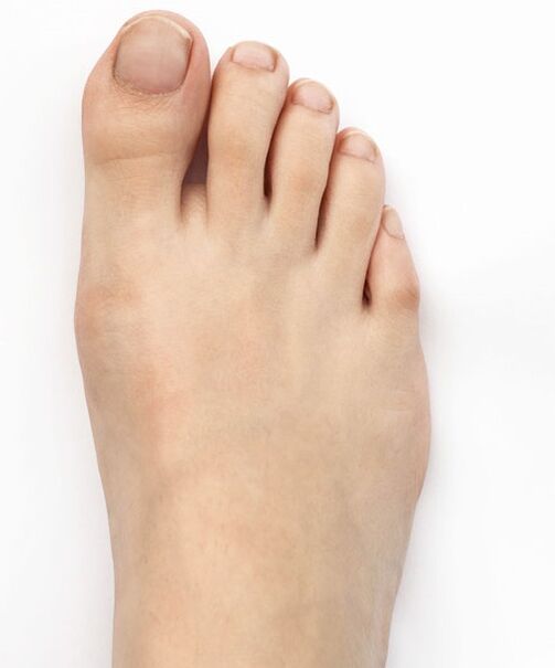 I treated my thumb valgus with Hondro Sol Valgus spray