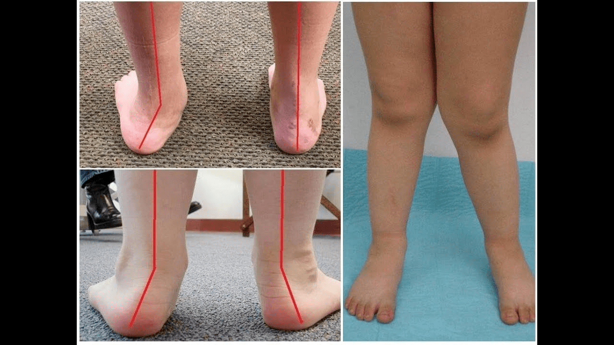 Types of deformities