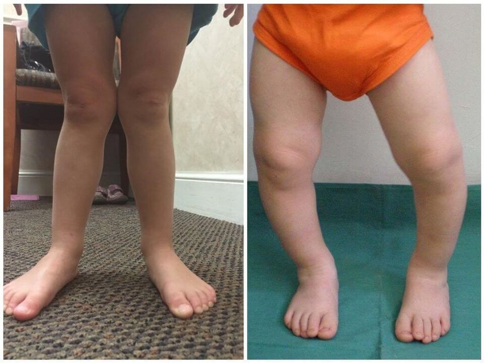 In children, valgus is caused by deformation