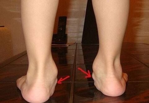 Feet fittings in children
