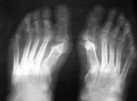 Tips for operations under the valgus of the leg