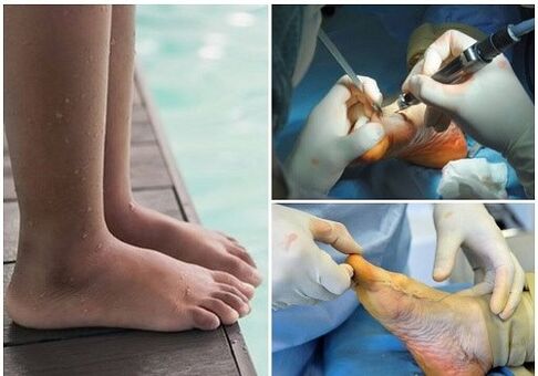 Small -Inasive Surgical Treatment