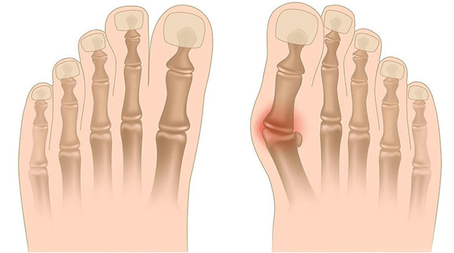 Treatment of Valgus Deformation