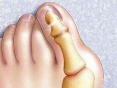 Hallux valgus deformasy
